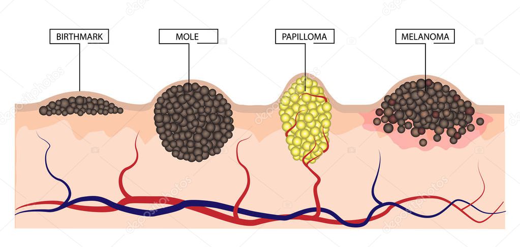 The difference between a birthmark, mole, papilloma and melanoma. Infographics
