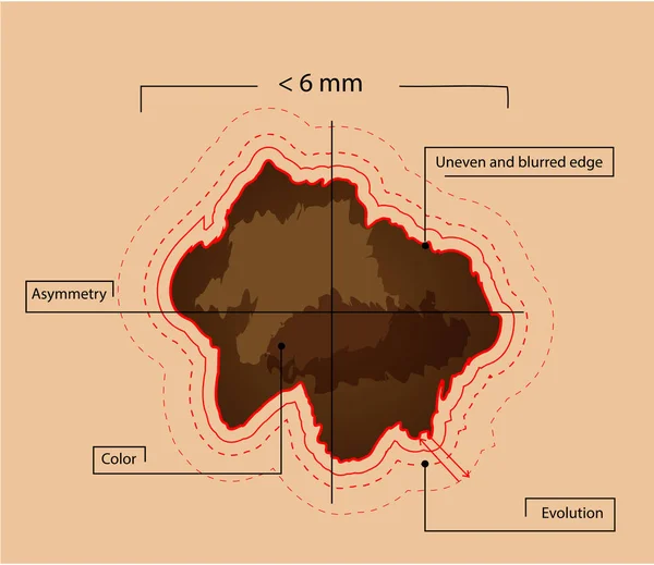 Sinais de melanoma maligno e toupeira. cancro da pele — Vetor de Stock