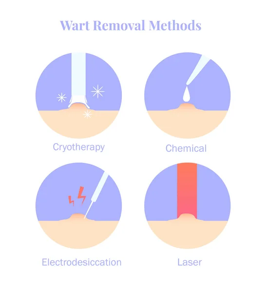 วิธีการกําจัดหูดของ infographics การบําบัดด้วย cryotherapy, Electrodesiccation, การกําจัดสารเคมีและเลเซอร์ . — ภาพเวกเตอร์สต็อก