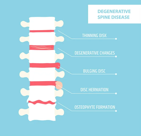 โรคแผ่นดิสก์เสื่อมสภาพ โรคข้ออักเสบที่กระดูกสันหลัง ไส้เลื่อน Vertebral — ภาพเวกเตอร์สต็อก