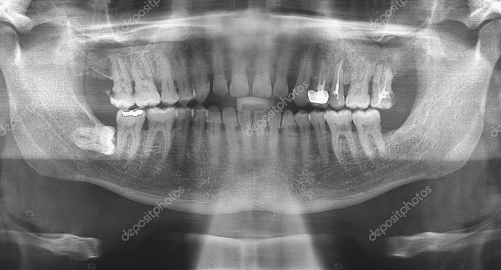Dental panoramic radiograph — Stock Photo © alfonsodetomas 139707980
