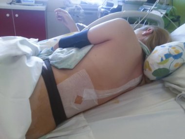 Kasılmalar ve epidural anestezi ile Doğum yeri kız yatıyor