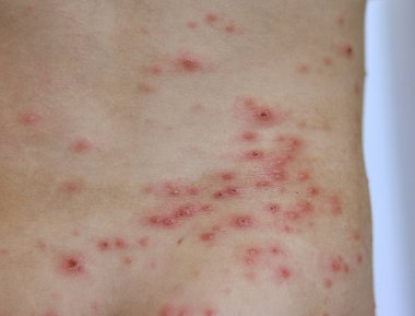 Portre Tavuk Pox'u döküntü - Viral enfeksiyonlar hastalığı Varisella