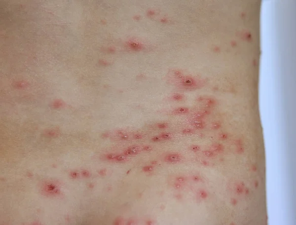 Closeup Chicken Pox Rash Infecções Virais Doença Varicela — Fotografia de Stock