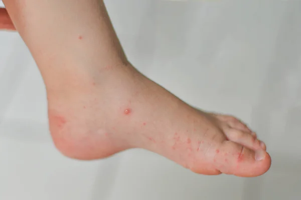 ( 영어 ) Enterovirus Leg arm mouth Rash on the body of a child Cockie virus — 스톡 사진