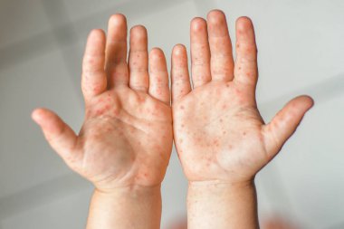 Enterovirüs Bacak Ağzı Bir Cocksackie virüsünün vücudunda döküntü