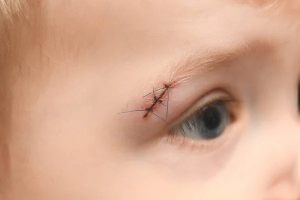 타박상을 아이의 눈썹에 상처를 — 스톡 사진