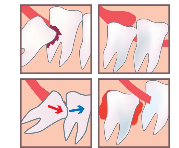Zęby mądrości procedury — Zdjęcie stockowe