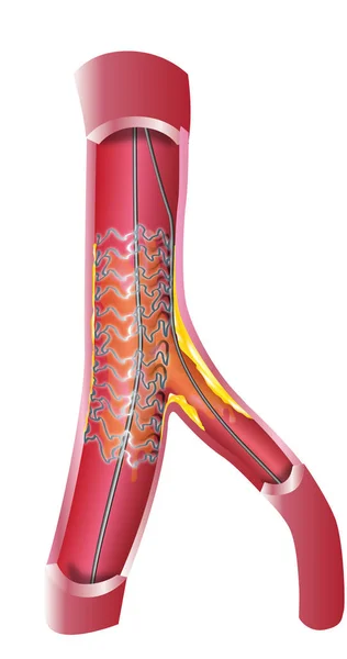 Καρδιακή φλέβα stent — Φωτογραφία Αρχείου