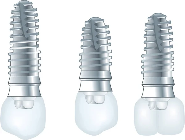 Ilustración de implantes dentales — Foto de Stock