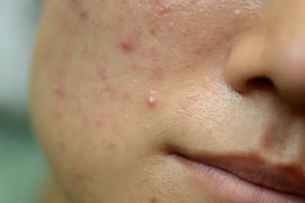 Jovem mulher asiática mostrando seu rosto com acne e toupeiras — Fotografia de Stock