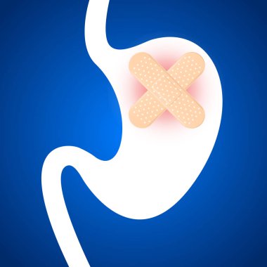 Gastrit, mide ülseri. Putters kapalı.
