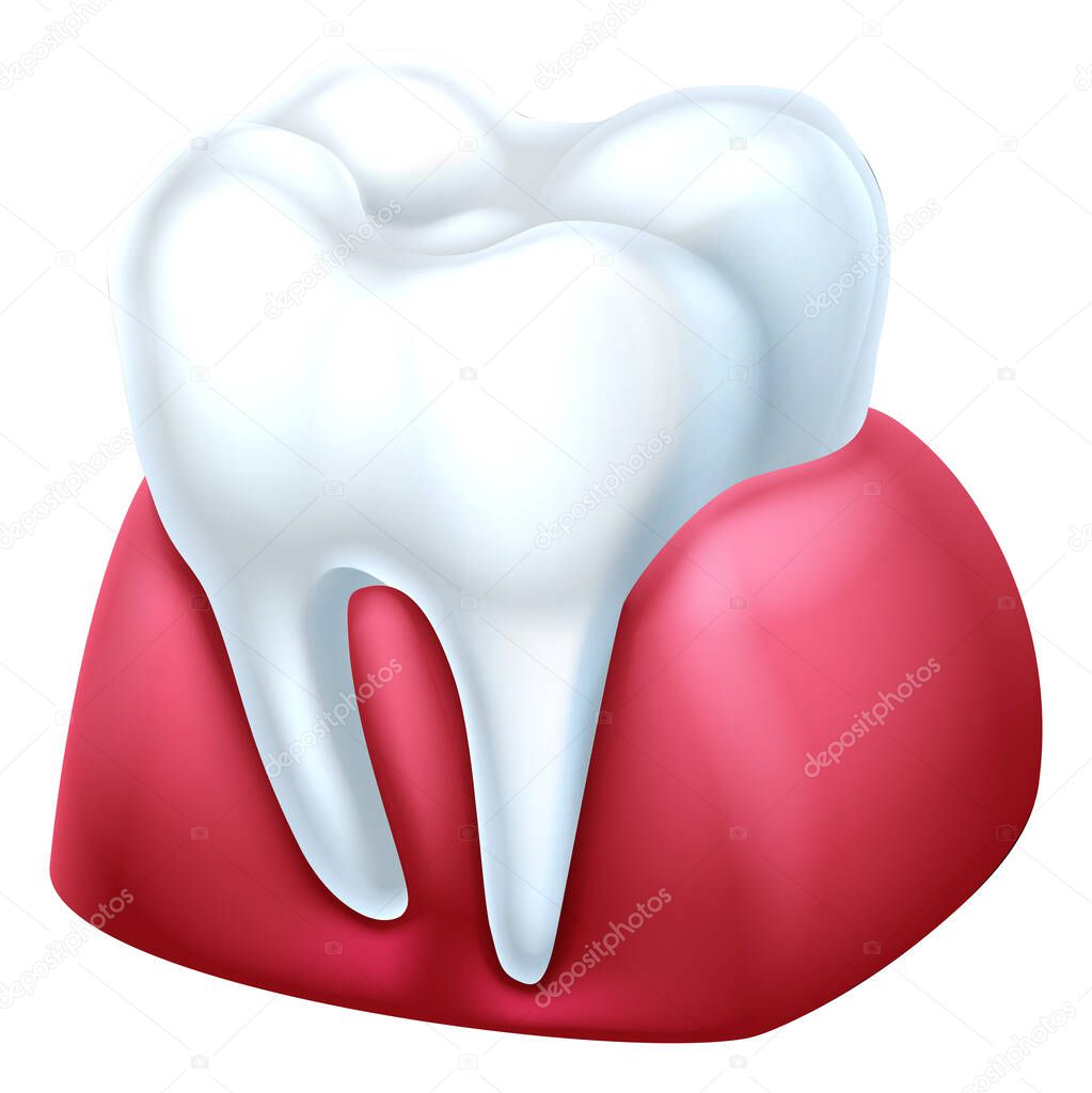 A dental medical illustration of a tooth and gum