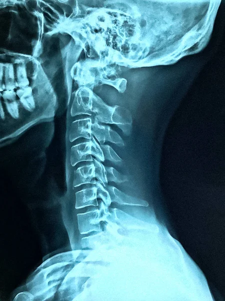 Röntgen des Halses — Stockfoto