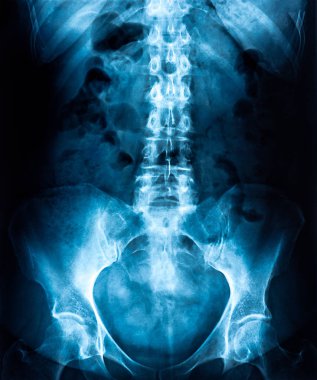 Lomber X-ray, alt sırt