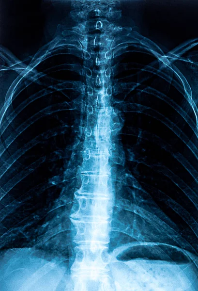 Imágenes: radiografías de columna lumbar | radiografía de columna