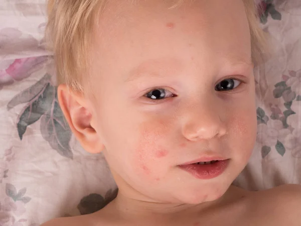 病気の子供の乾燥肌 子供と健康 乾燥肌 赤ちゃんは病気です 小児の病気や治療法 赤ちゃんのアレルギー 薬と薬 — ストック写真