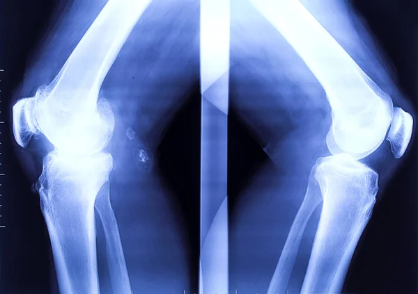 X-ray of the two bended knees — Stock Photo, Image