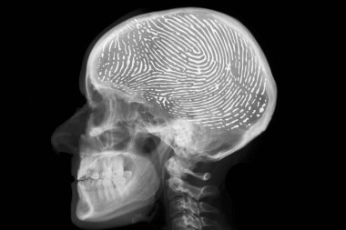Beyinde parmak izi ile insan kafası X-Ray