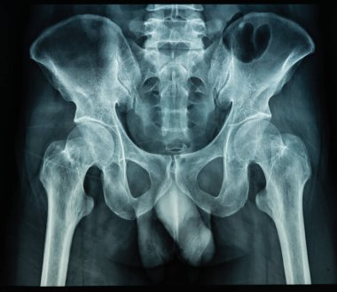 Siyah arka planda insan palvis X Ray dosya