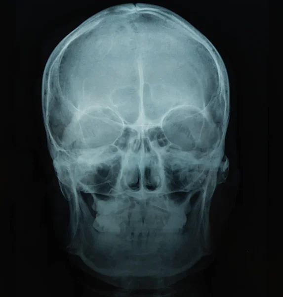 Röntgenbild eines menschlichen Schädels auf schwarzem Hintergrund — Stockfoto