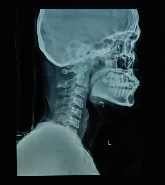 黒の背景に人間の頭蓋骨の X 線ファイル — ストック写真