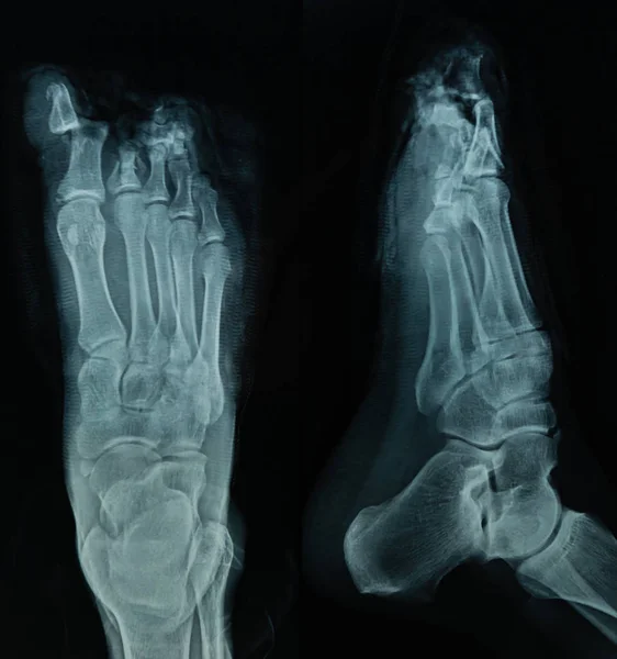 Archivo de rayos X del pie humano en fondo negro —  Fotos de Stock