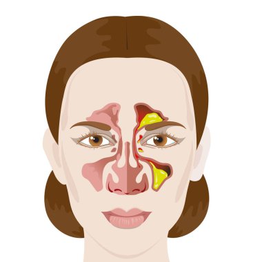 Sinüzit. Sağlıklı ve iltihaplı sinüsler