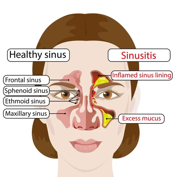 Sinusite. Sinusite saudável e inflamada. Cartaz médico Vetores De Bancos De Imagens