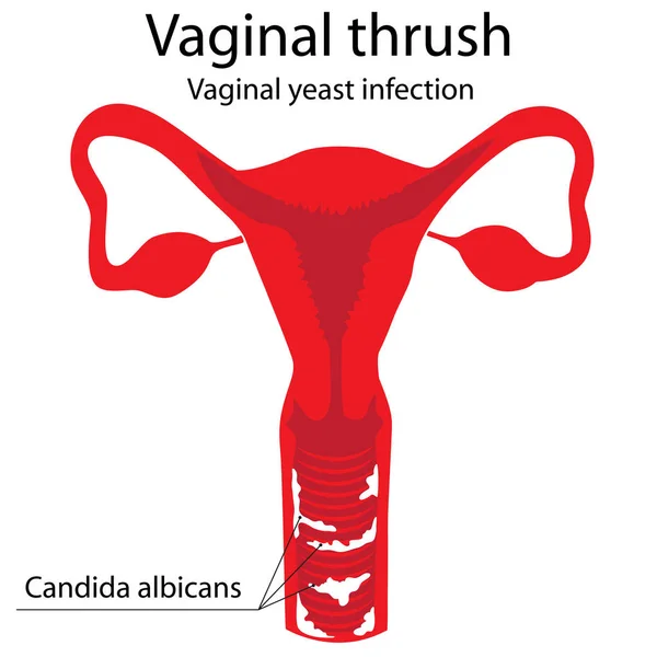Cartaz de candidíase vaginal —  Vetores de Stock