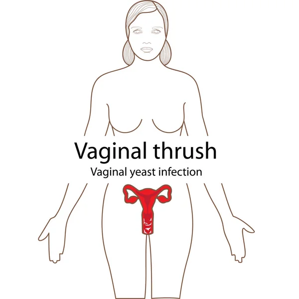 Tordo vaginal no corpo Ilustrações De Bancos De Imagens Sem Royalties