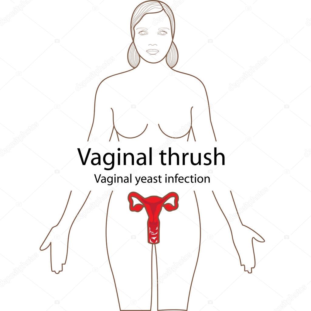 Vaginal thrush in  the body