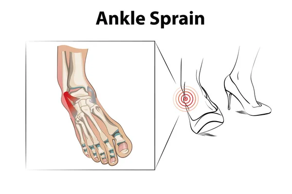 Ankle Sprain Injury Wearing High Heels — Stock Vector