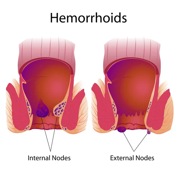 Hémorroïdes Nœuds Externes Internes — Image vectorielle