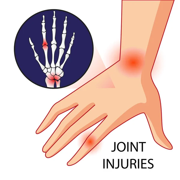 Illustratie vector van bot en gezamenlijke kniepijn — Stockvector