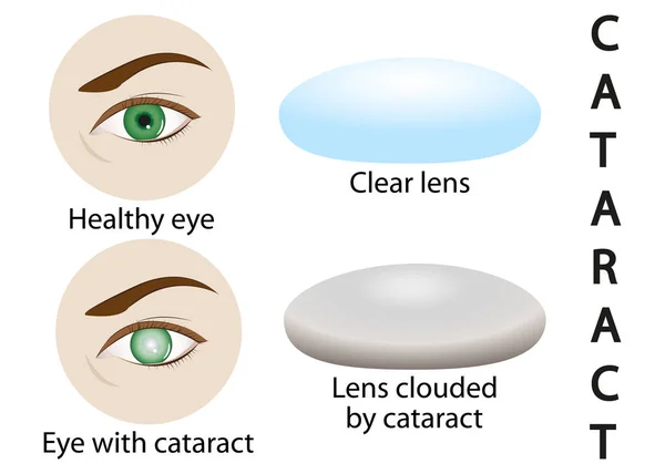 Ilustração de um olho saudável, glaucoma, catarata — Vetor de Stock