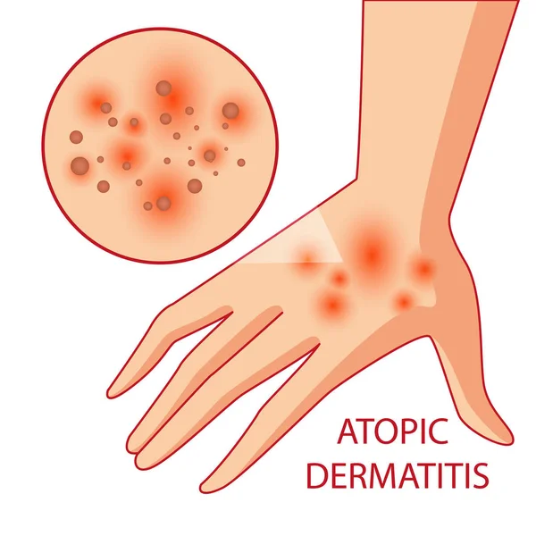 Illustration av atopisk dermatit. allergier. dermatologi. inflammation — Stock vektor