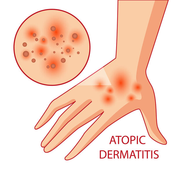 illustration of atopic dermatitis. allergies. dermatology. inflammation