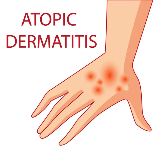 Illustration atopischer Dermatitis. Allergien. Dermatologie. Entzündung — Stockvektor