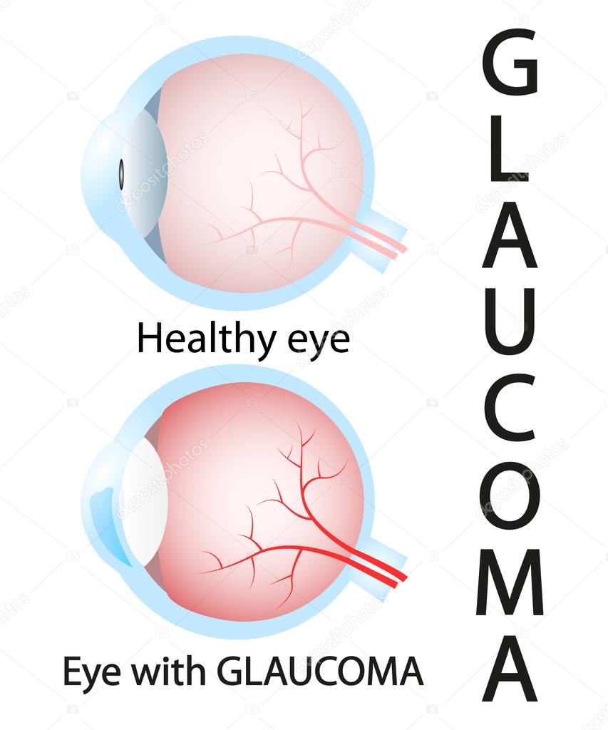 Glaucoma and healthy eye detailed structure.