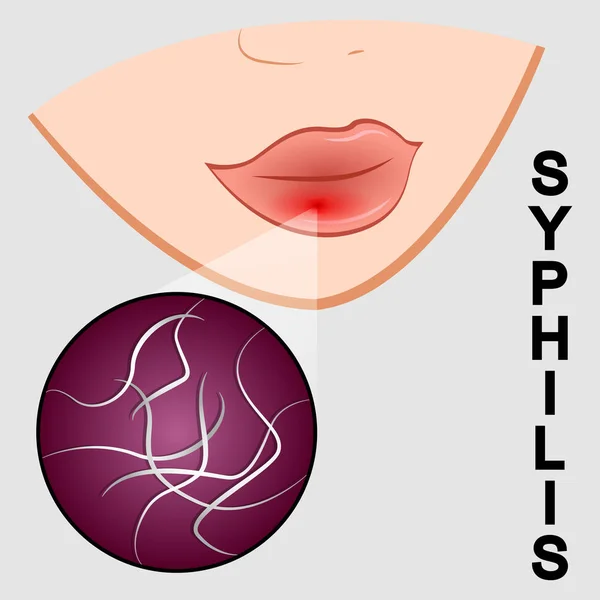 Ilustración de la sífilis. síntomas y agente causal — Vector de stock