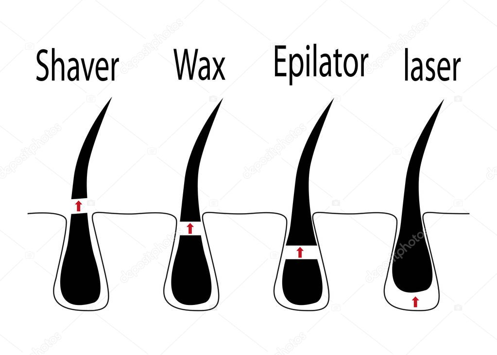 Vector Diagram Of Different Methods Of Hair Removal