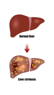 Hepatit karaciğer hastaları. Yankısı alkolizm. Beyaz illüstrasyon izole