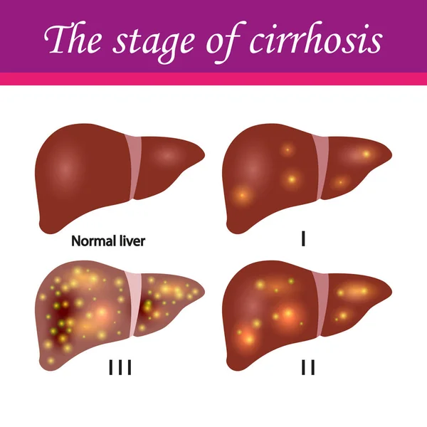 Cirrose dos estádios hepáticos —  Vetores de Stock