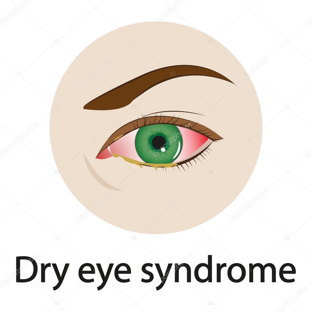 Dry eye syndrome. Vector illustration.