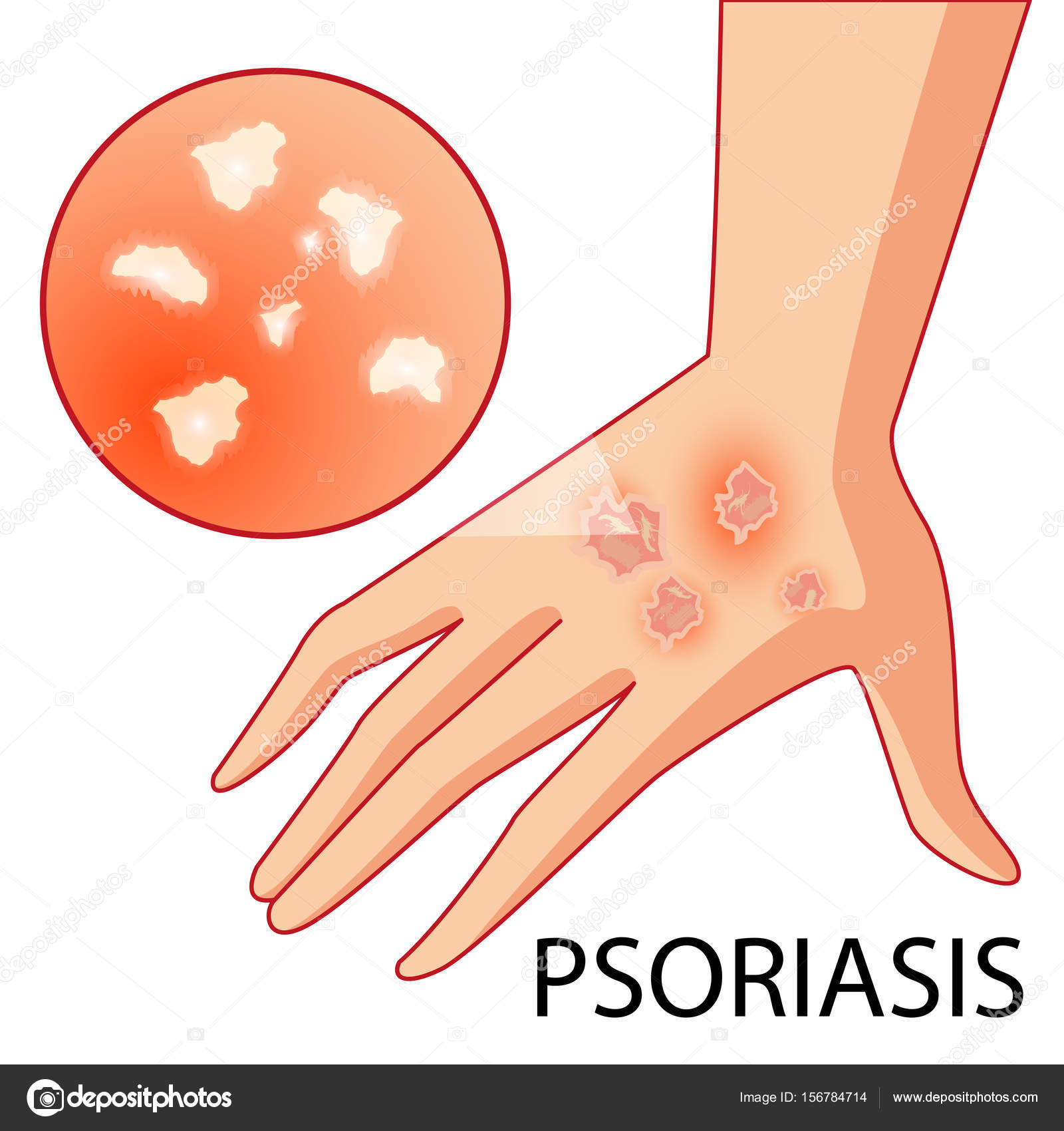 Psoriasis kezelésére Kínában