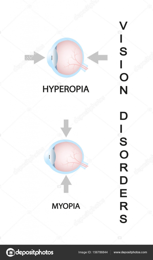 Vision minus 1 - what does it mean, can Myopia be cured - is it minus or plus 37 Vision minus 1 - what does it mean, can Myopia be cured - is it minus or plus 69