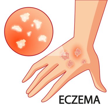 Sedef hastalığı. Cilt sorunları. Vektör. Çizgi film. İzole. Düz. Gösterim amacıyla Web siteleri, broşür, dergi. Tıp.