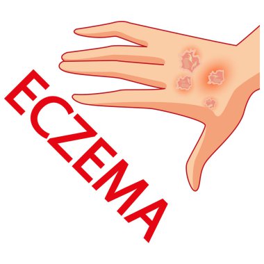 Sedef hastalığı. Cilt sorunları. Vektör. Çizgi film. İzole. Düz. Gösterim amacıyla Web siteleri, broşür, dergi. Tıp.