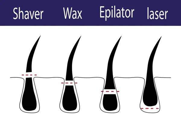 Vektorový diagram různých metod odstraňování chlupů — Stockový vektor